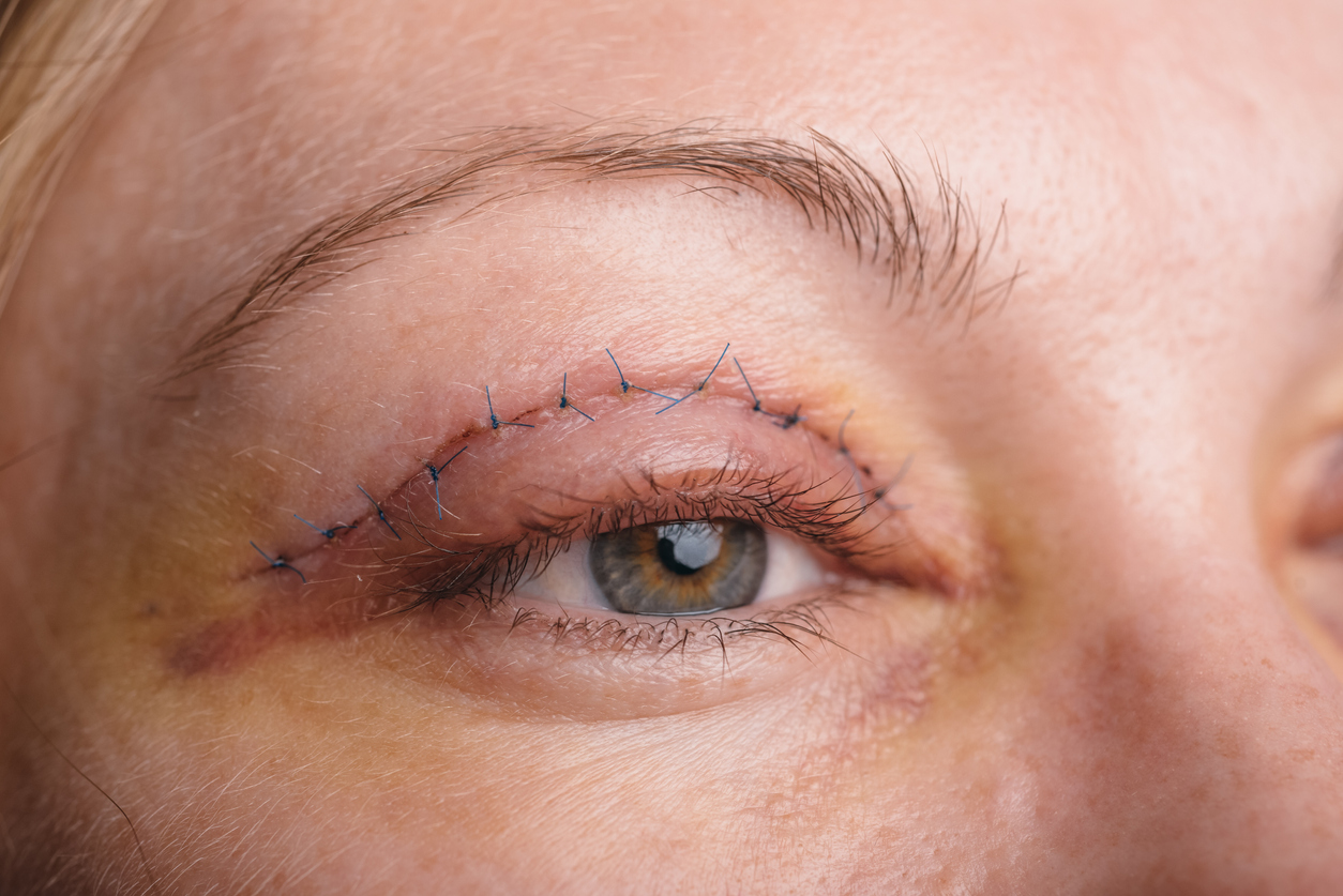 eyelid surgery pictures