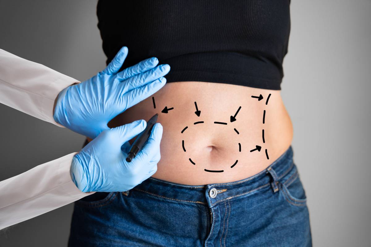 How a Tummy Tuck Is the Best Procedure for Your 40s