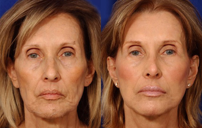 Facelift with Necklace, USIC Cheeklift, Lateral Browlift, Livefill to Naso Labial Folds and Lips, Upper Lip Lift, Rhinoplasty, Co2 Laser