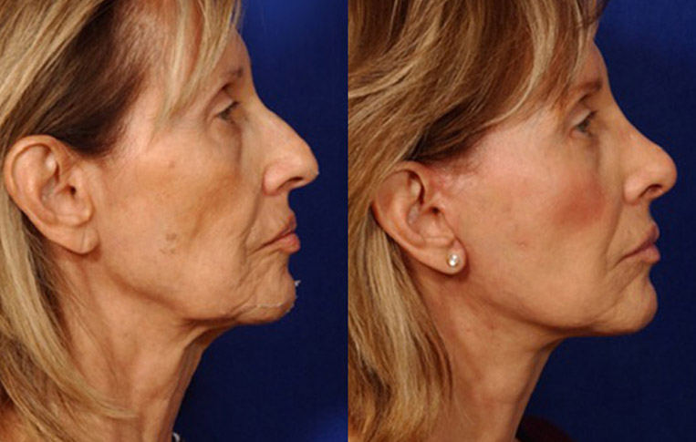 Facelift with Necklace, USIC Cheeklift, Lateral Browlift, Livefill to Naso Labial Folds and Lips, Upper Lip Lift, Rhinoplasty, Co2 Laser