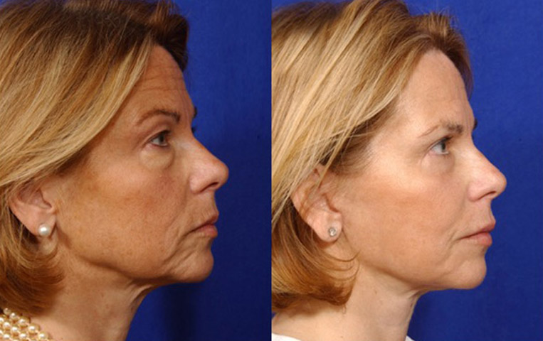 Facelift with Necklace, USIC Cheeklift, Lateral Browlift, Livefill to Naso Labial Folds and Lips, Upper Lip Lift, Rhinoplasty, Co2 to Face and Neck