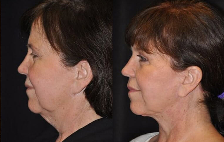 Facelift with Necklace, Earlobe Revision, Livefill to Lips, USIC Cheeklift, Upper Blepharoplasty