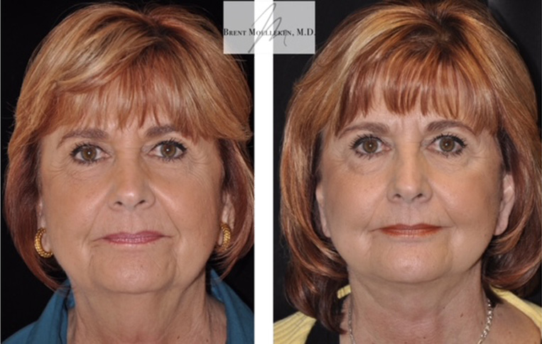 Facelift with Necklace and Upper Blepharoplasty