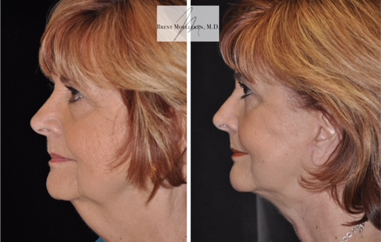 Facelift with Necklace and Upper Blepharoplasty