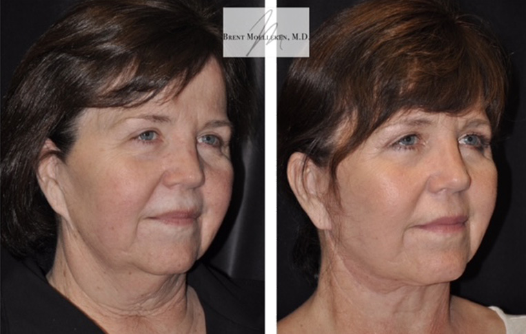 Facelift with Necklace, Earlobe Revision, Livefill to Lips, USIC Cheeklift, Upper Blepharoplasty