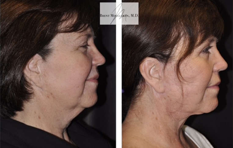 Facelift with Necklace, Earlobe Revision, Livefill to Lips, USIC Cheeklift, Upper Blepharoplasty