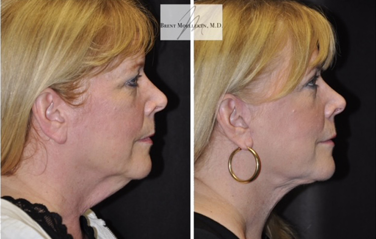 Facelift with Necklace, Lateral Browlift, USIC Cheeklift, Transconjunctival Lower Blepharoplasty, Co2 Laser to Face