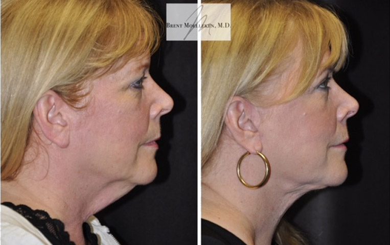 Facelift with Necklace, Lateral Browlift, USIC Cheeklift, Transconjunctival Lower Blepharoplasty, Co2 Laser to Face