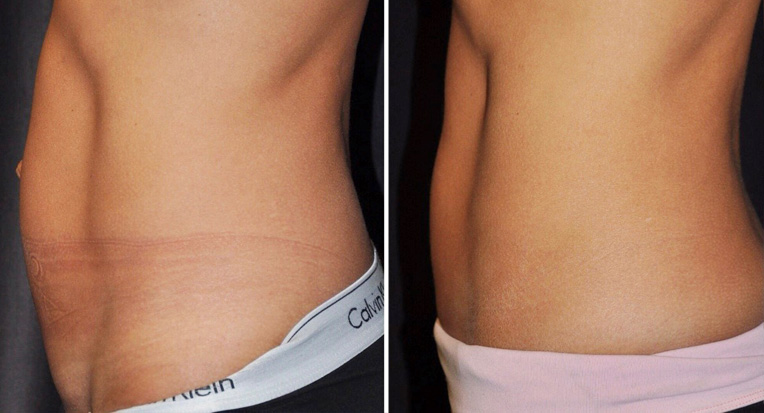 Hybrid Tummy Tuck