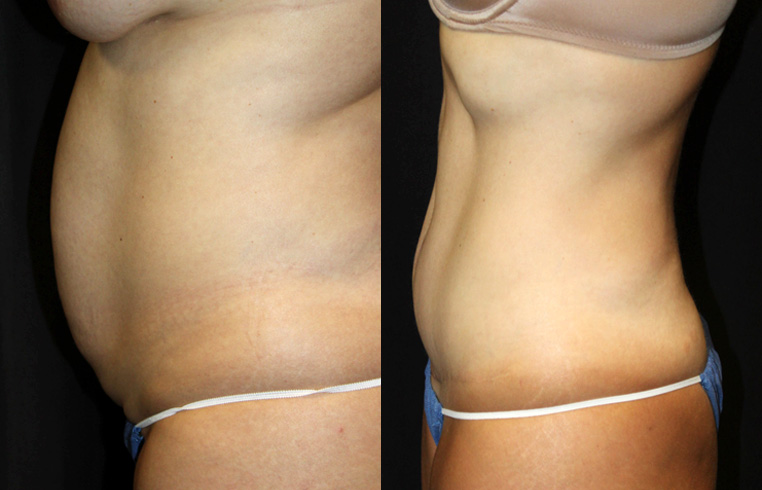 2.5 years after tummy tuck with vertical incision