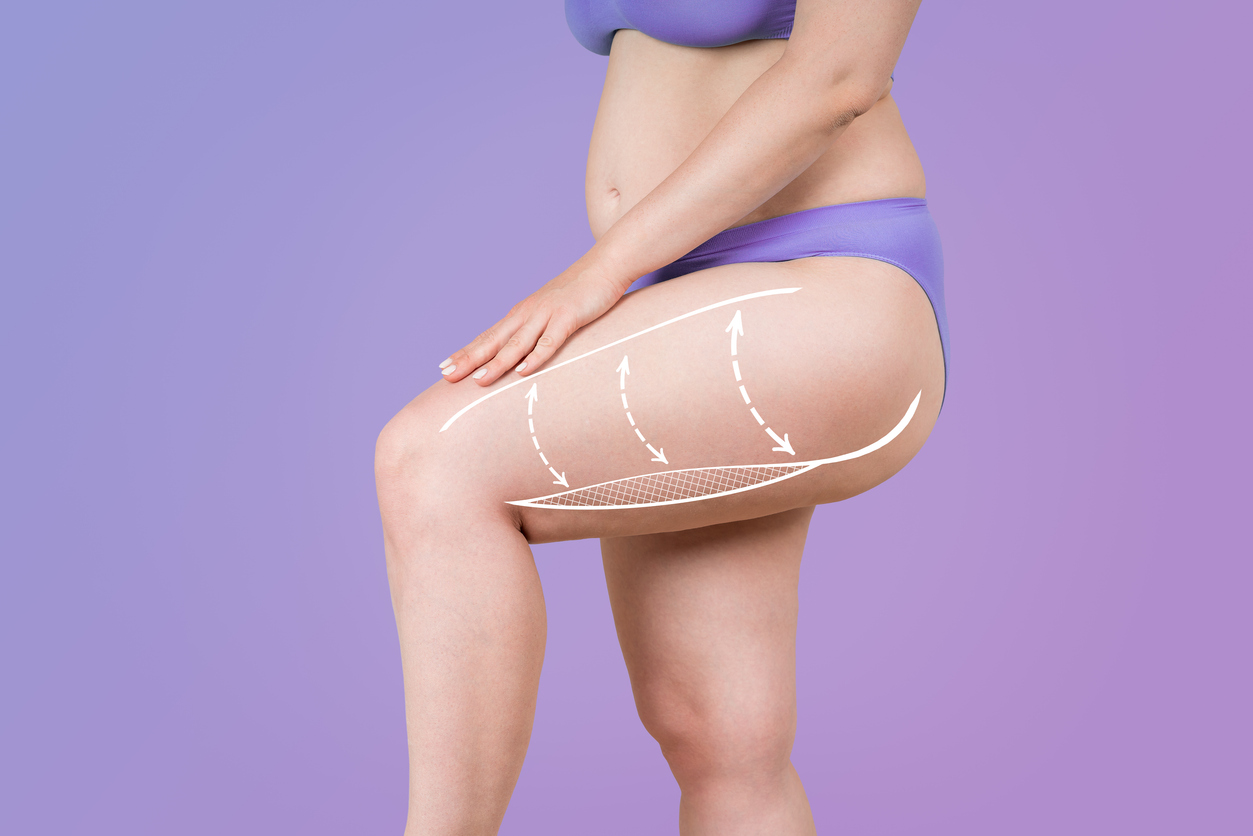The image shows a body with proposed edits to show who is a good candidate for a thigh lift.
