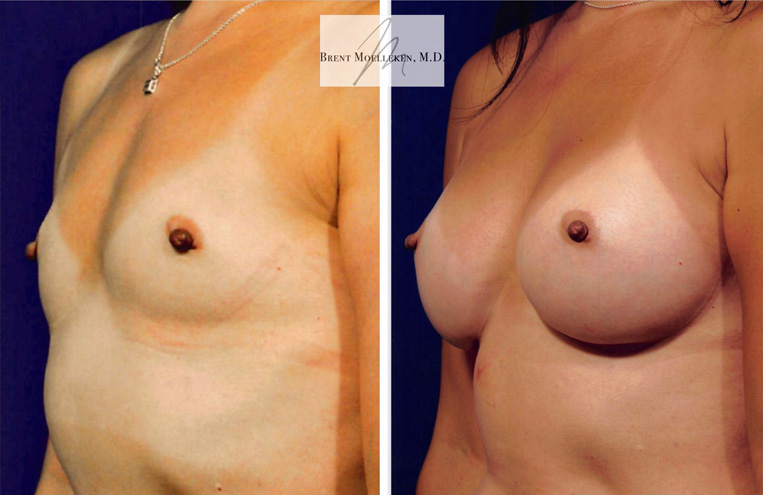 Breast Augmentation with 375cc Saline Implants Subpectoral Placement