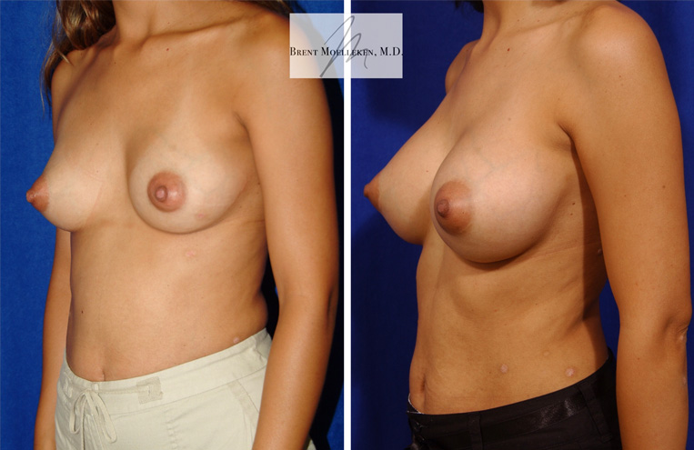 Breast Augmentation