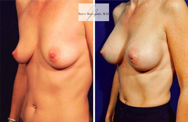 Breast Augmentation with 330 cc Saline Implants