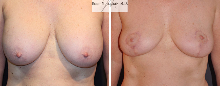 Breast Reduction with Mastopexy