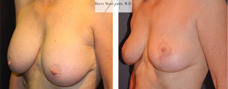 Breast Reduction with Mastopexy