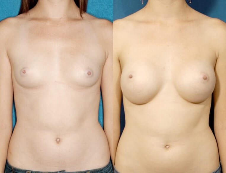 Breast augmentation with smooth saline implants, size 390cc, inflated to 400cc – inframammary incision.