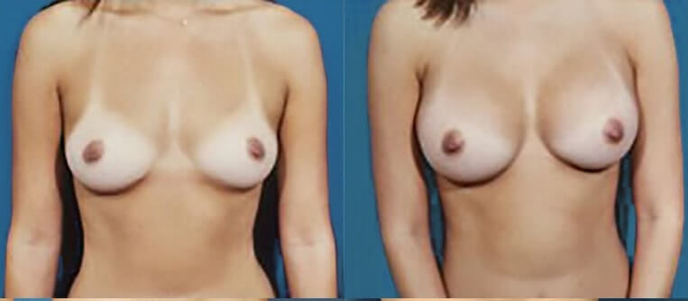 Breast augmentation with smooth saline implants, size 330cc.