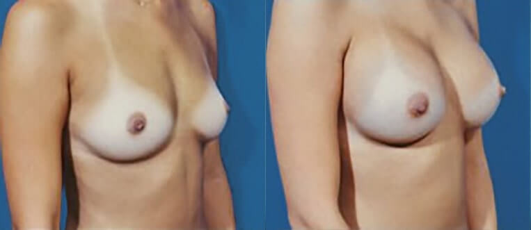 Breast augmentation with smooth saline implants, size 330cc.