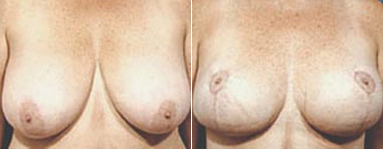 Breast reduction with lift.