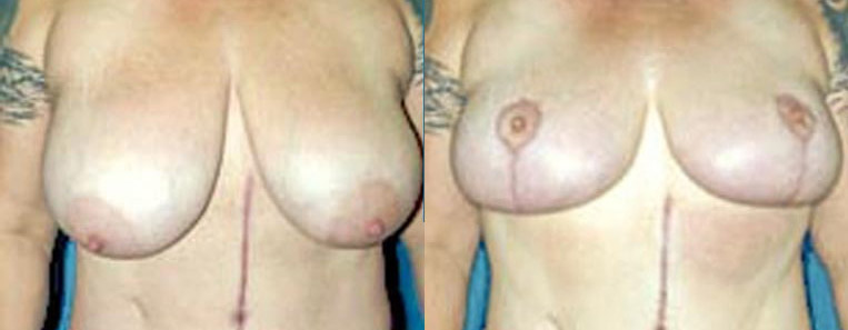 Breast Reduction