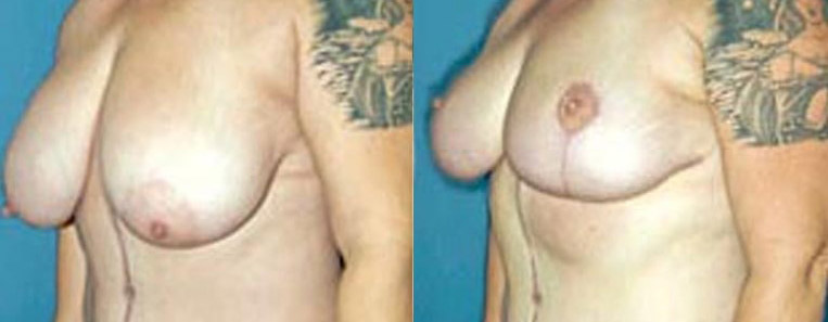 Breast Reduction