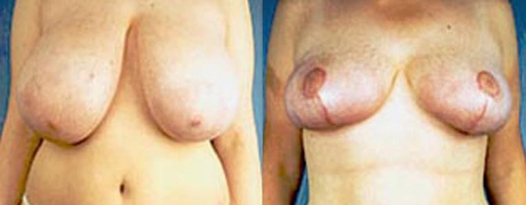 Breast Reduction