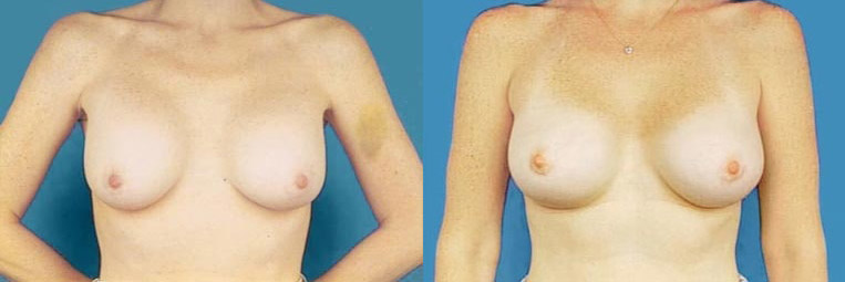 Revision to implant placed above the muscle and nipple asymmetry.