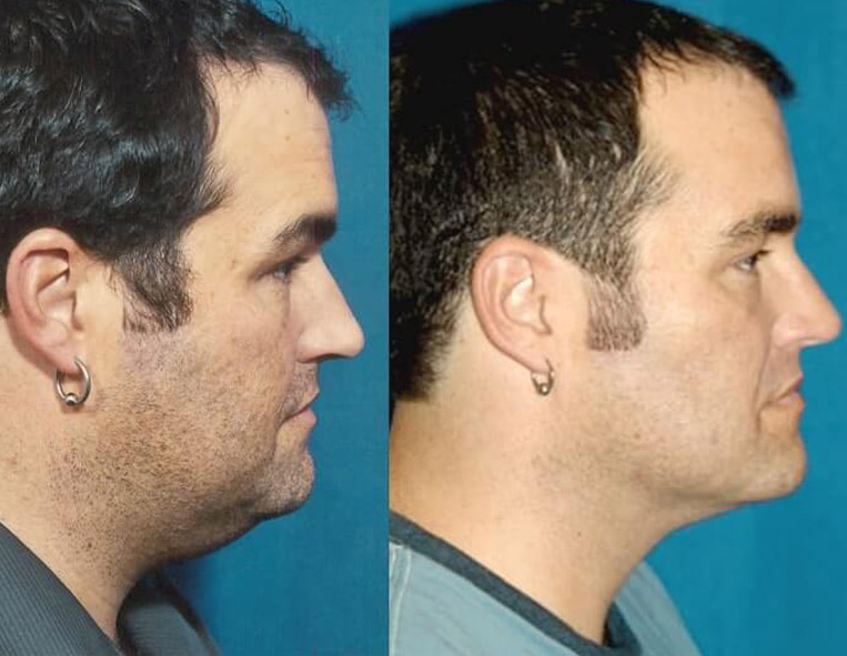 Buccal Fat Removal