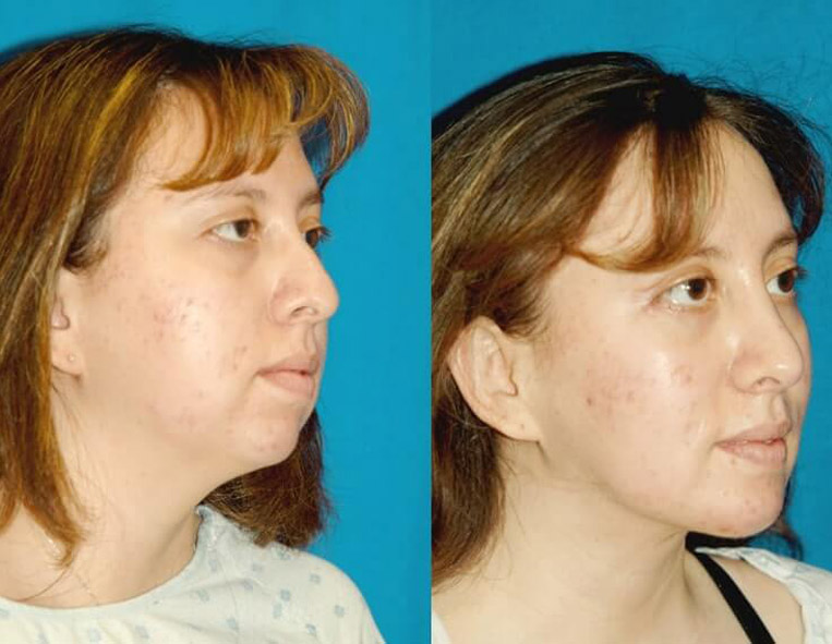 Buccal Fat Liposuction