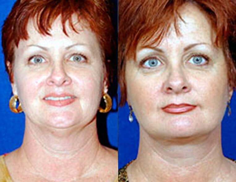 Buccal Fat Liposuction