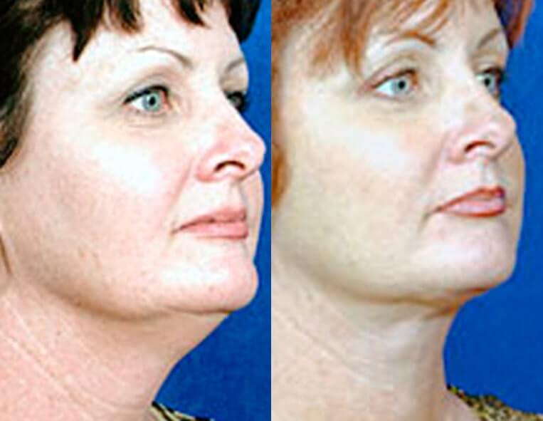 Buccal Fat Liposuction