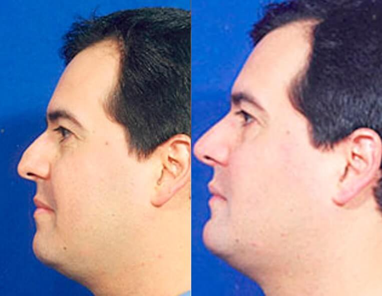 Buccal Fat Pad Removal