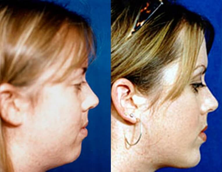 Buccal Fat Liposuction