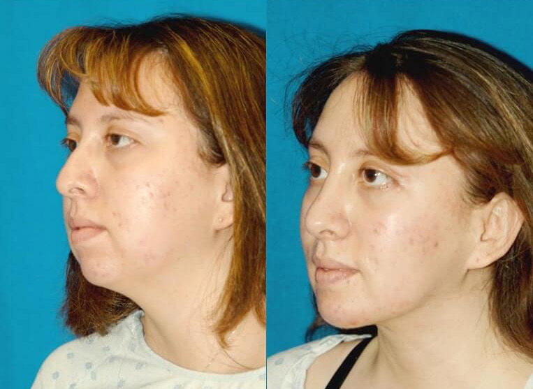 Chin Implants