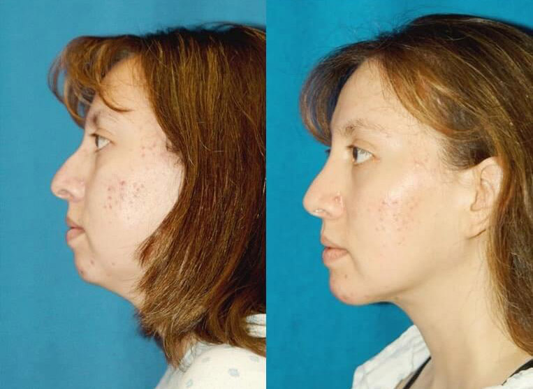 Chin Implants