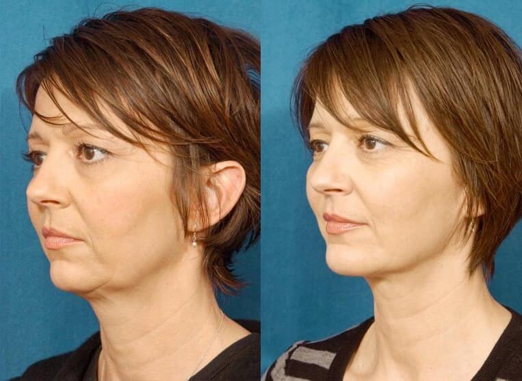 Chin Implants