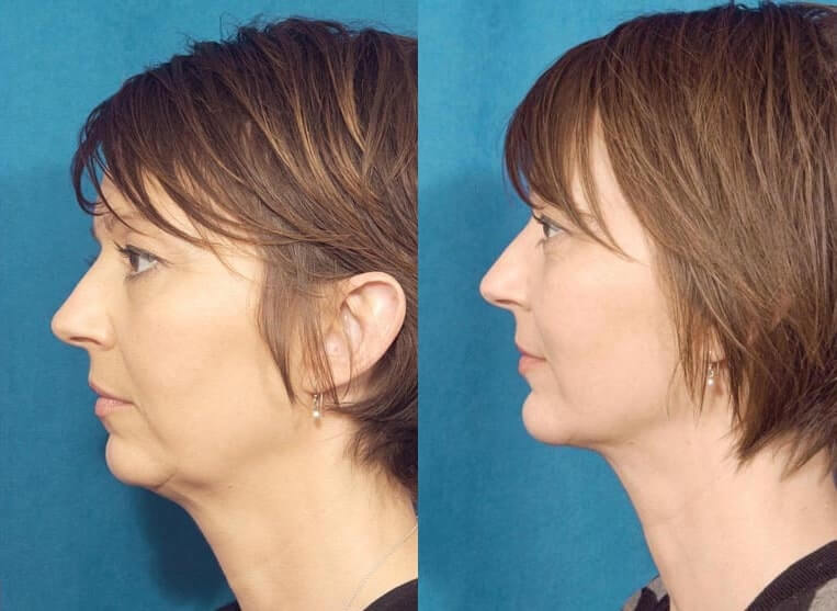 Chin Implants