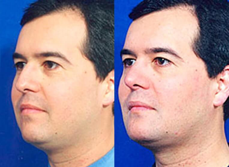 Chin Implants