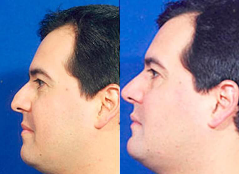 Chin Implants