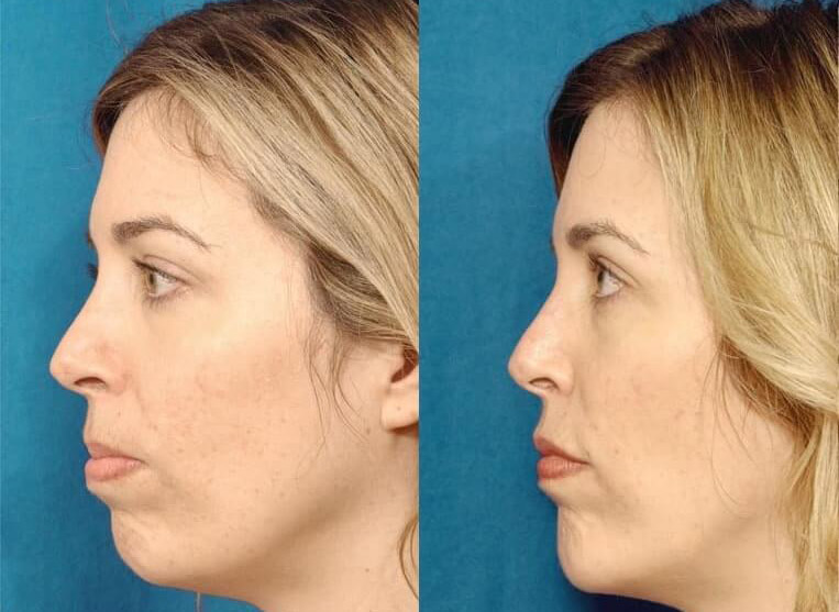 Chin Implants