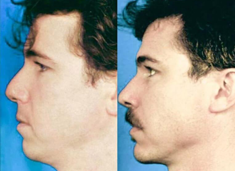 Chin Implants