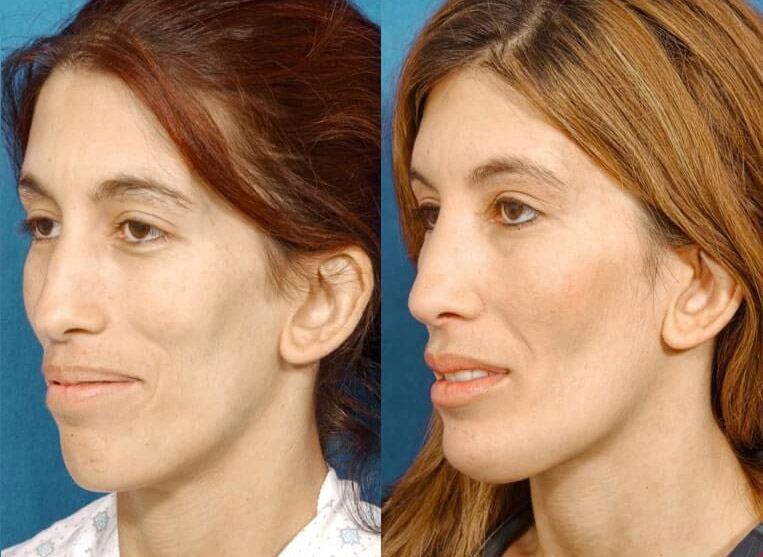 Chin Implants