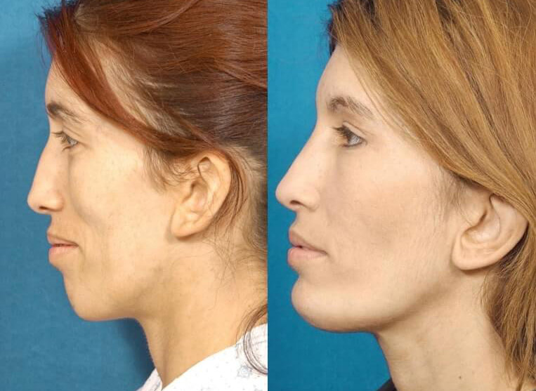 Chin Implants