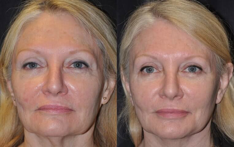 Facelift with Necklace © and upper blepharoplasty.