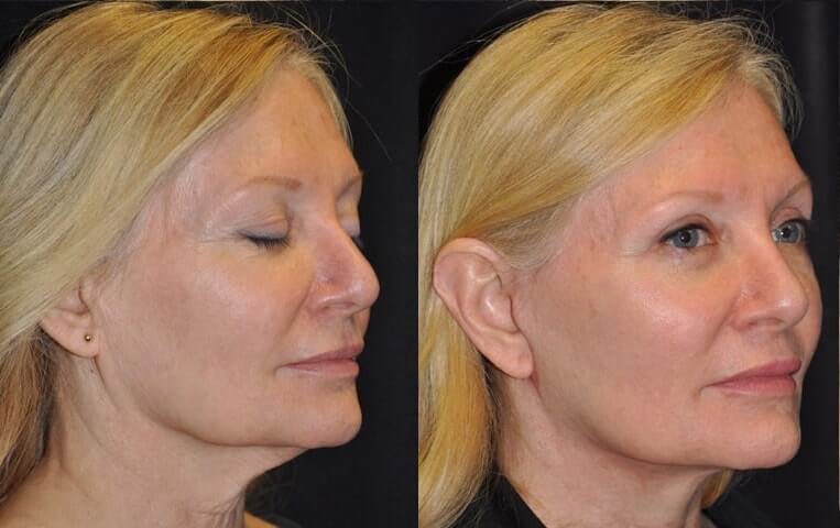 Facelift with Necklace © and upper blepharoplasty.