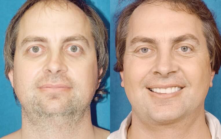 Blepharoplasty