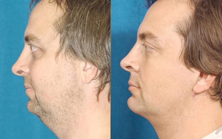 Blepharoplasty