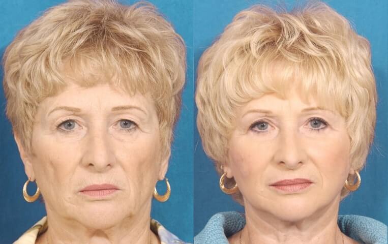 Blepharoplasty