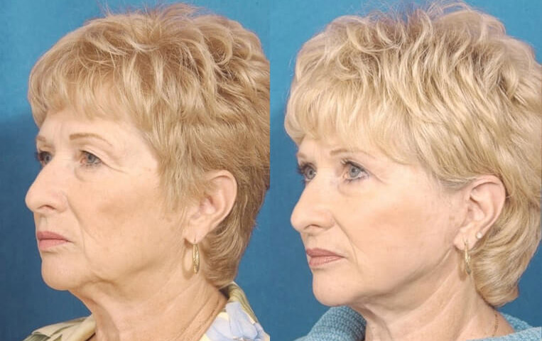 Blepharoplasty